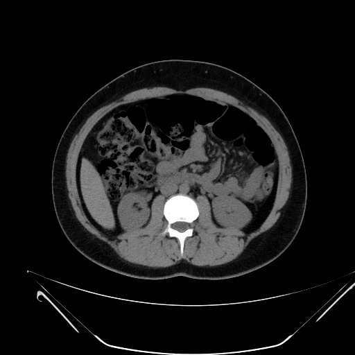 Bilateral ovarian mature cystic teratomas (Radiopaedia 79373-92457 Axial non-contrast 28).jpg