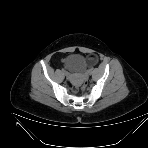 File:Bilateral ovarian mature cystic teratomas (Radiopaedia 79373-92457 Axial non-contrast 59).jpg