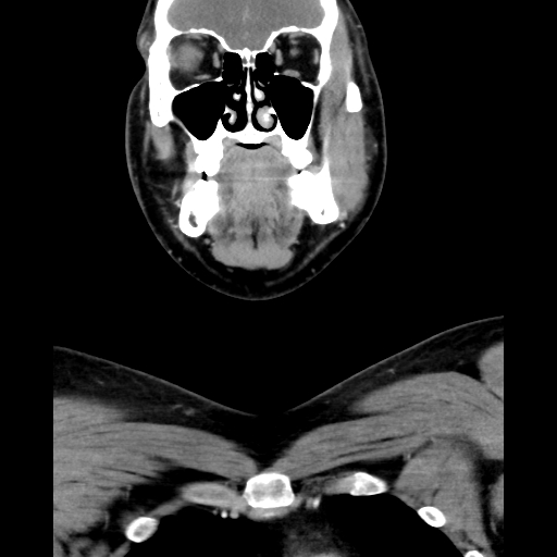 Bilateral peritonsillar abscess (Radiopaedia 85065-100610 Coronal 22).jpg