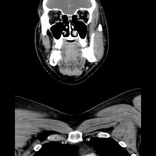 Bilateral peritonsillar abscess (Radiopaedia 85065-100610 Coronal 23).jpg