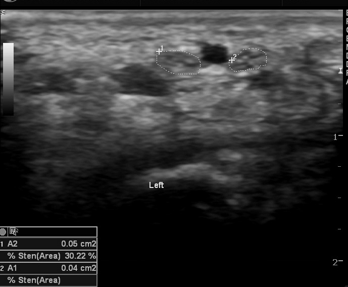 File:Bilateral persistent median artery of the forearm with unilateral bifid median nerve (Radiopaedia 17430-17121 D 1).jpg