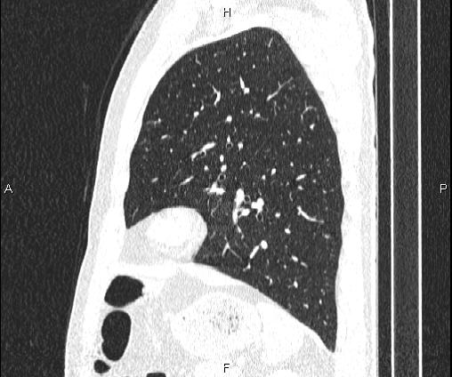 Bilateral pulmonary AVM (Radiopaedia 83134-97505 Sagittal lung window 83).jpg