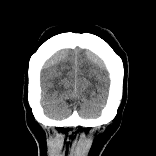Bilateral subacute subdural hematoma (Radiopaedia 69240-79018 Coronal non-contrast 51).jpg