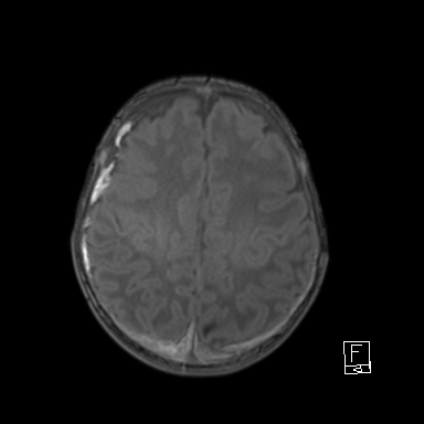 Bilateral subdural hemorrhage and parietal skull fracture (Radiopaedia 26058-26190 Axial T1 39).png