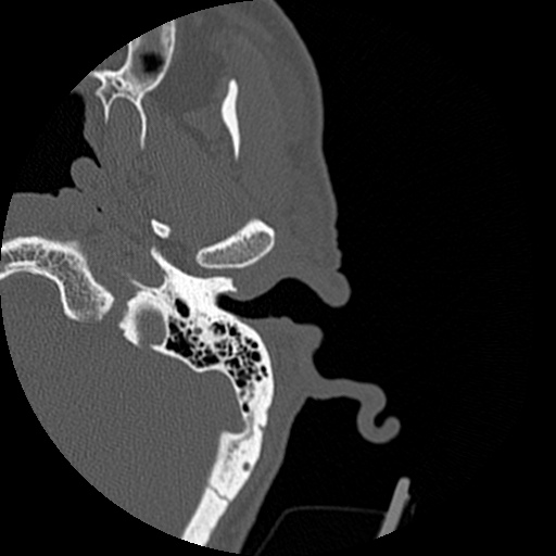 File:Bilateral temporal bone fractures (Radiopaedia 29482-29970 D 39).jpg