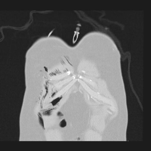 File:Bilateral traumatic renovascular injury (Radiopaedia 32051-32995 Coronal lung window 5).jpg
