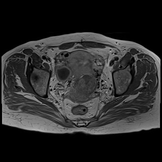 Bilateral tubo-ovarian abscesses (Radiopaedia 58635-65829 Axial T1 C+ 30).jpg