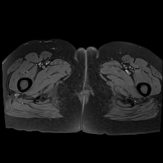 Bilateral tubo-ovarian abscesses (Radiopaedia 58635-65829 Axial T1 fat sat 52).jpg