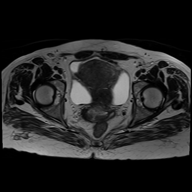 Bilateral tubo-ovarian abscesses (Radiopaedia 58635-65829 Axial T2 32).jpg