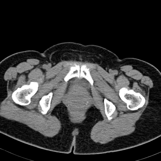 Bilateral ureteric stents (Radiopaedia 48795-53825 Axial non-contrast 70).jpg