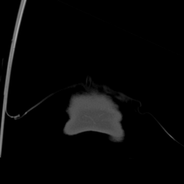 Biparietal osteodystrophy (Radiopaedia 46109-50463 Coronal bone window 110).jpg