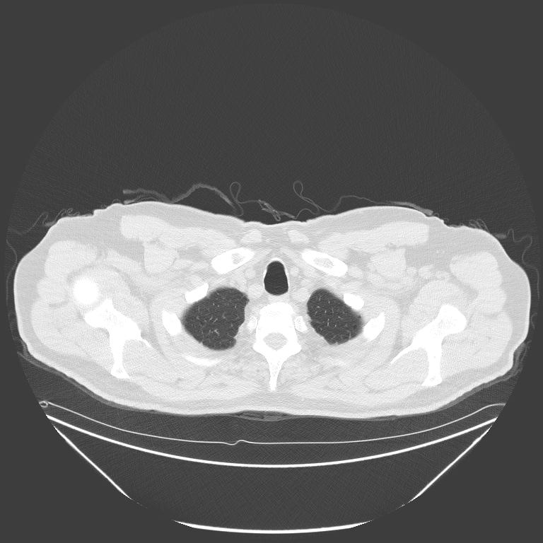 Birt-Hogg-Dubé syndrome (Radiopaedia 52578-58491 Axial lung window 4).jpg