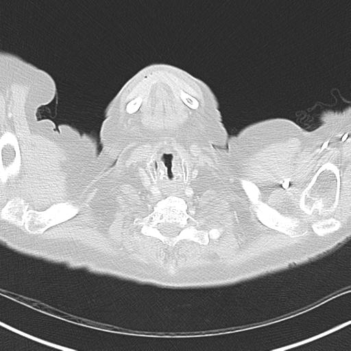 File:Bladder and bowel cancers (Radiopaedia 37688-39592 Axial lung window 1).png
