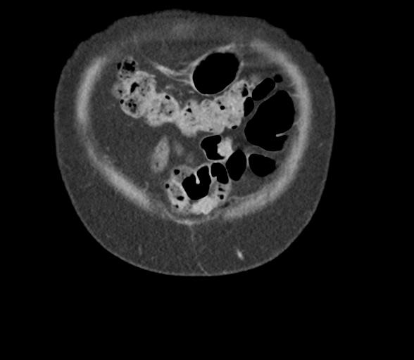 File:Bladder papillary urothelial carcinoma (Radiopaedia 48119-52951 C 8).png