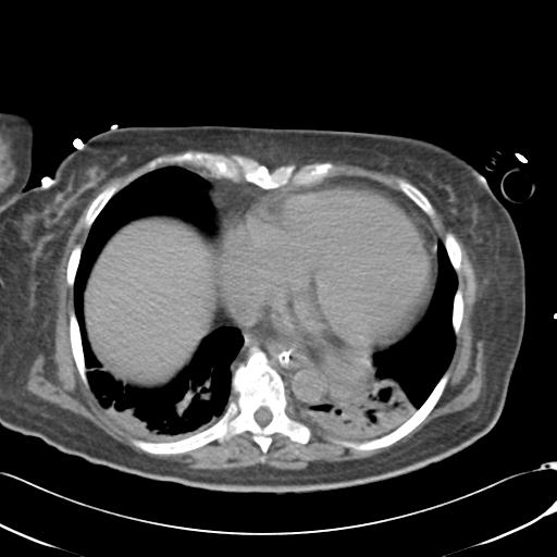 Bladder rupture post renal biopsy (Radiopaedia 30863-31572 Axial non-contrast 7).jpg