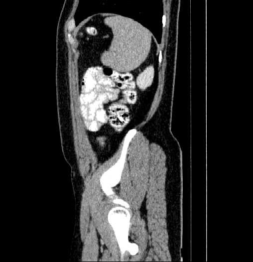 Blind-ending branch of a bifid ureter (Radiopaedia 61159-69048 E 74).jpg