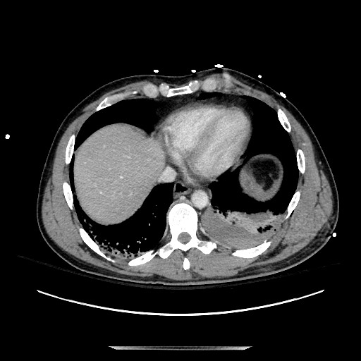Blunt abdominal trauma with solid organ and musculoskelatal injury with active extravasation (Radiopaedia 68364-77895 A 10).jpg