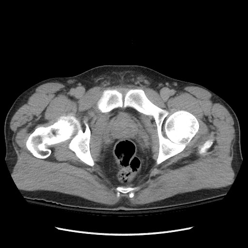 Blunt abdominal trauma with solid organ and musculoskelatal injury with active extravasation (Radiopaedia 68364-77895 Axial C+ delayed 134).jpg