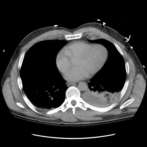 Blunt abdominal trauma with solid organ and musculoskelatal injury with active extravasation (Radiopaedia 68364-77895 Axial C+ delayed 5).jpg