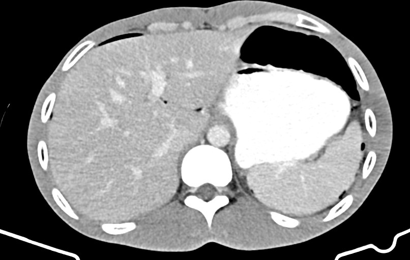 Blunt injury to the small bowel (Radiopaedia 74953-85987 A 18).jpg