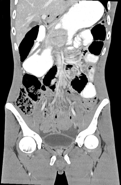 Blunt injury to the small bowel (Radiopaedia 74953-85987 B 40).jpg