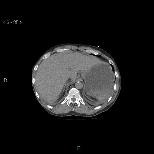 Boerhaave syndrome (Radiopaedia 27683-27897 Axial non-contrast 85).jpg