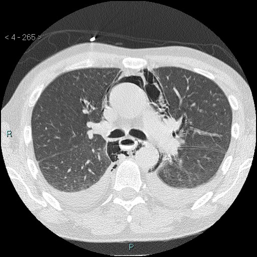 Boerhaave syndrome (Radiopaedia 27683-27897 lung window 21).jpg