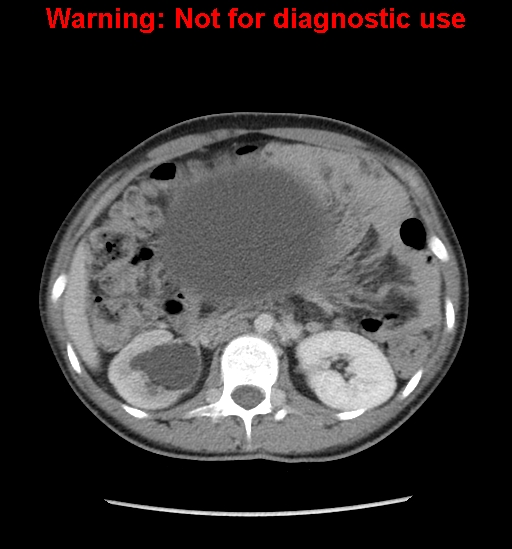 Borderline mucinous cystadenoma of ovary (Radiopaedia 25586-25767 A 6).jpg