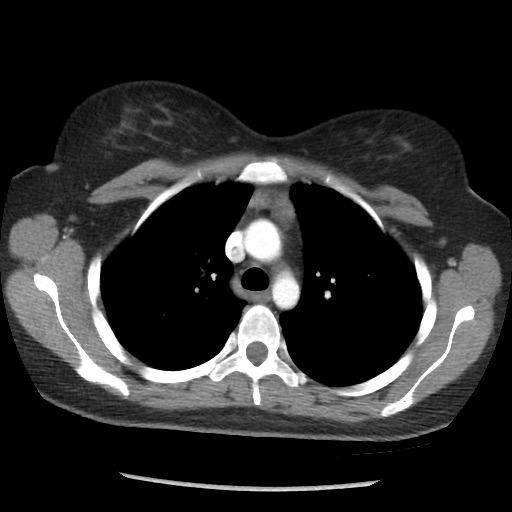 File:Borderline mucinous tumor (ovary) (Radiopaedia 78228-90808 A 16).jpg