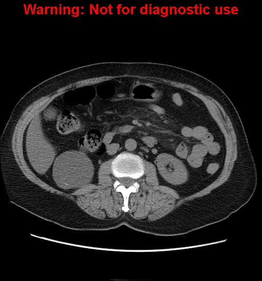 File:Bosniak renal cyst - type II (Radiopaedia 23404-23468 Axial non-contrast 18).jpg