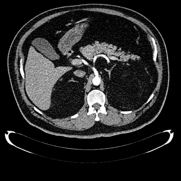 Bosniak renal cyst - type IV (Radiopaedia 24244-24518 B 100).jpg