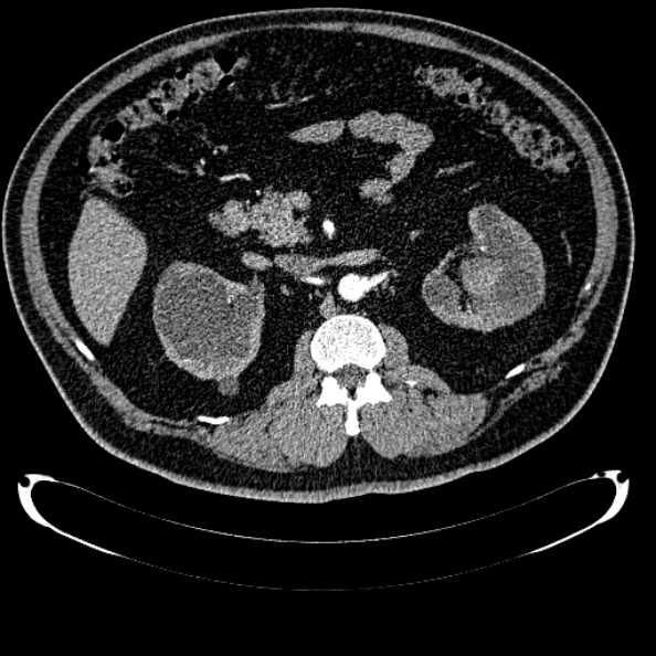 File:Bosniak renal cyst - type IV (Radiopaedia 24244-24518 B 133).jpg