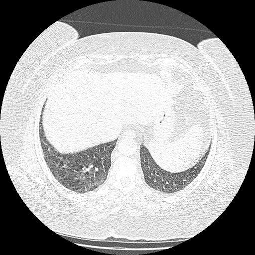 Bovine aortic arch - right internal mammary vein drains into the superior vena cava (Radiopaedia 63296-71875 Axial lung window 132).jpg