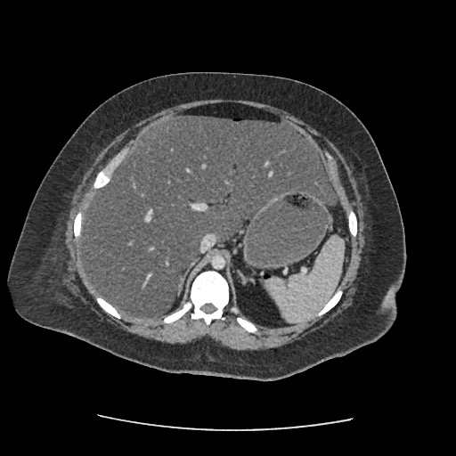 Bowel and splenic infarcts in acute lymphocytic leukemia (Radiopaedia 61055-68915 A 42).jpg
