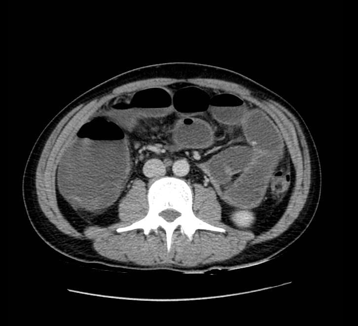 Bowel obstruction from colon carcinoma (Radiopaedia 22995-23028 A 43).jpg