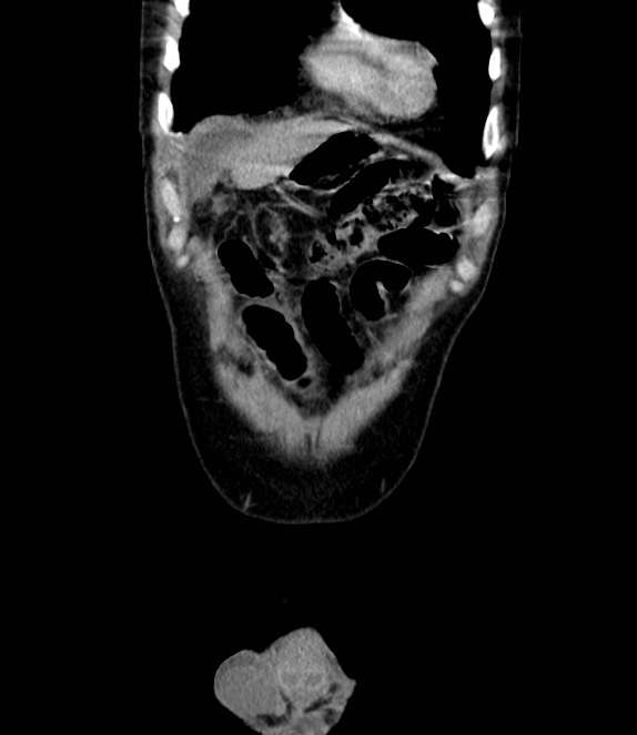 Bowel obstruction from colon carcinoma (Radiopaedia 22995-23028 C 9).jpg