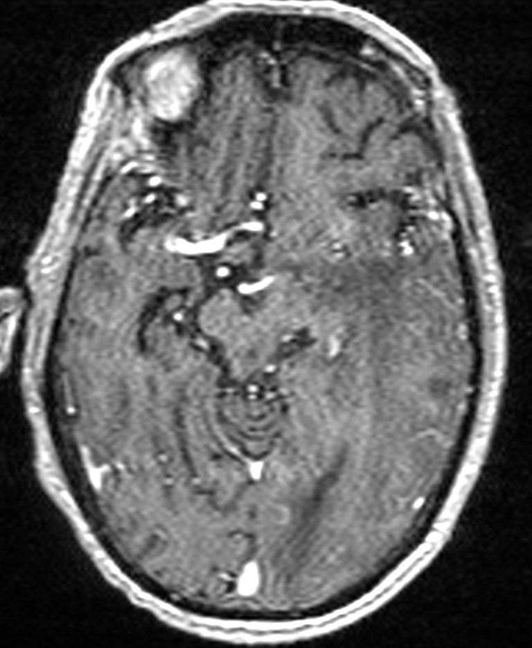 Brain abscess with dual rim sign (Radiopaedia 87566-103938 Axial T1 C+ 72).jpg