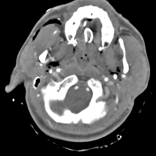 Brain contusions, internal carotid artery dissection and base of skull fracture (Radiopaedia 34089-35339 D 51).png