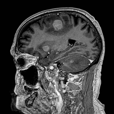 Brain metastases from lung cancer (Radiopaedia 83839-99028 Sagittal T1 C+ 43).jpg