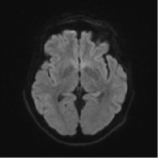 Brain metastasis (sarcoma) (Radiopaedia 47576-52209 Axial DWI 41).png