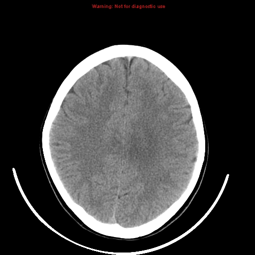 File:Brainstem glioma (Radiopaedia 9444-10123 non-contrast 17).jpg