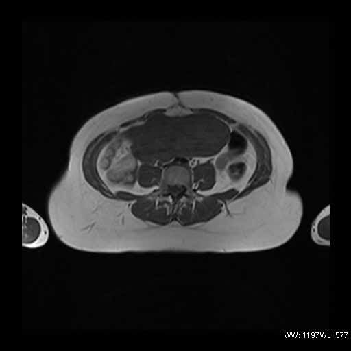 File:Broad ligament fibroid (Radiopaedia 49135-54241 Axial T1 3).jpg