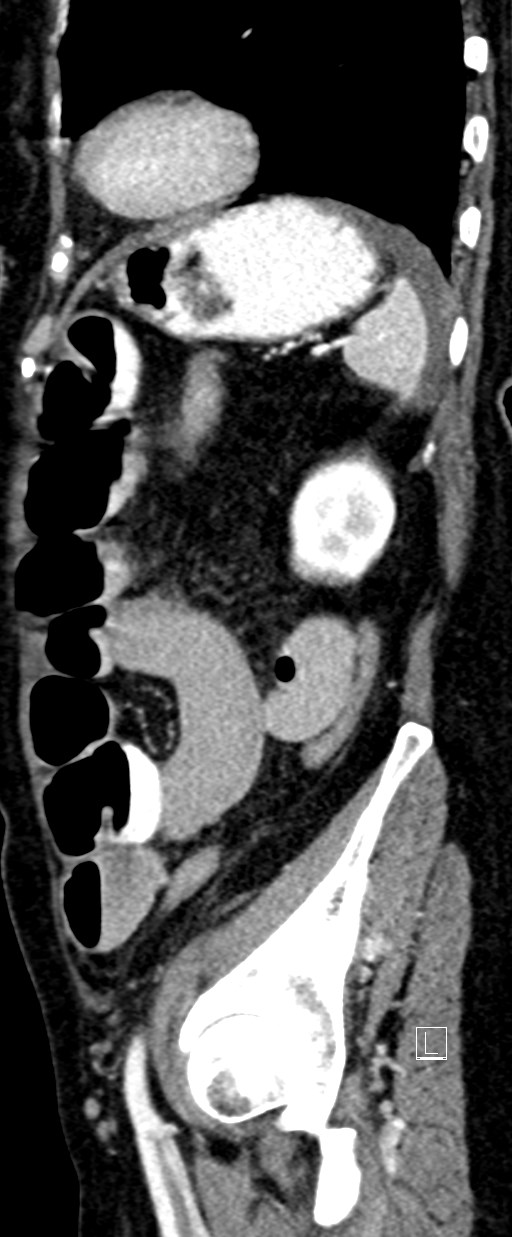 Broad ligament hernia (Radiopaedia 84802-100276 C 15).jpg