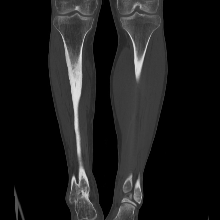 Brodie abscess - tibia (Radiopaedia 66028-75204 Coronal bone window 37).jpg