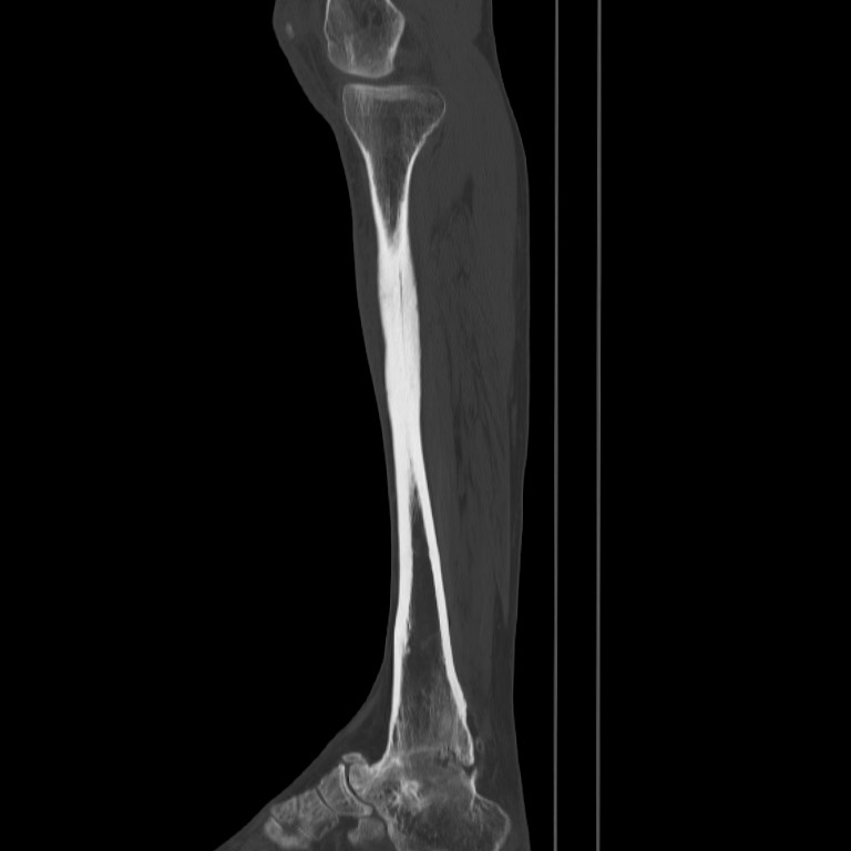 Brodie abscess - tibia (Radiopaedia 66028-75204 Sagittal bone window 22).jpg