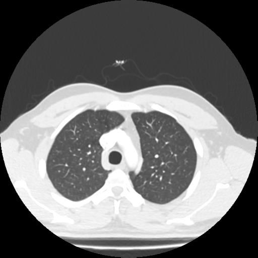Bronchial carcinoid (Radiopaedia 80013-93291 Axial lung window 21).jpg