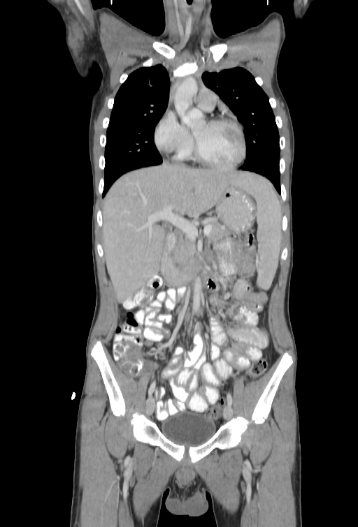 Bronchial carcinoid tumor (Radiopaedia 57187-64090 B 25).jpg
