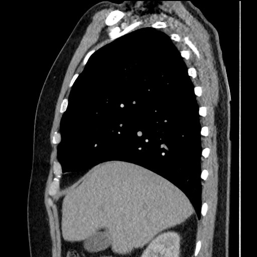 File:Bronchial carcinoid tumor (Radiopaedia 67377-76764 E 20).jpg