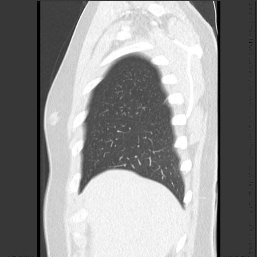 Bronchial carcinoid tumor (Radiopaedia 67377-76764 Sagittal lung window 11).jpg
