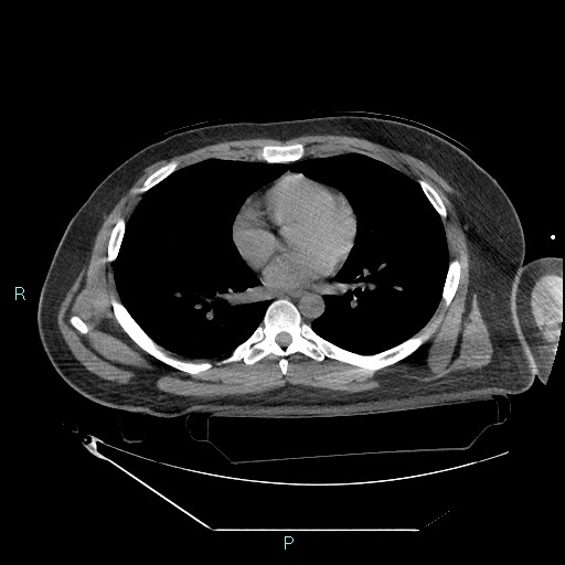 File:Bronchial carcinoid tumor (Radiopaedia 78272-90870 Axial non-contrast 61).jpg
